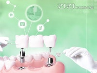 TheAreumDaun(더아름다운 | [서관성의 더 아름다운 치아] 임플란트 종류 다양해... 나에게 맞는 장치 선택이 중요