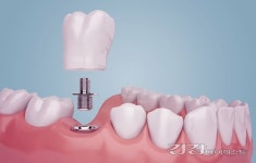 [덴탈칼럼] 저작 기능과 경제적 비용 고려한다면 임플란트틀니도 한 방법