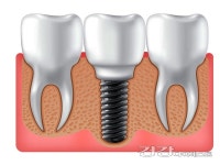 노인 임플란트, 꼼꼼한 검진으로 진행 가능 여부 확인해야