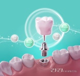[김광수의 치아시크릿] 임플란트 만능주의가 위험한 이유