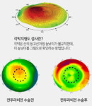 야간 빛 번짐 예방하는 컨투라비전 라섹이란? 