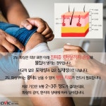[카드뉴스] 응급처치, 심재성, 치료, 흉터… 화상에 대한 지식 알아보기