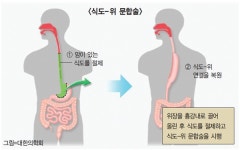술‧담배 모두 즐기면 식도암 발병률 50배 높아