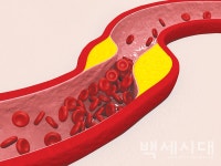 콜레스테롤 쌓여 동맥벽 좁아지면 경화증 나타나는 동맥경화증의 증상과 치료