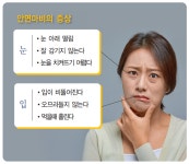 '안면마비' 신속 치료 안하면 신경 손상돼 후유증