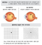 사물이 찌그러져 보이는 황반변성… 75세 이후 급증