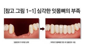 임플란트 불가능한 잇몸 뼈의 부족, 뼈를 잘 만드는 노하우가 중요
