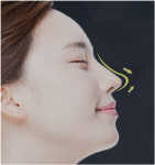 코필러 부작용 염려된다면, 하이코 및 텍스코로 자연스런 콧대 만들 수 있어
