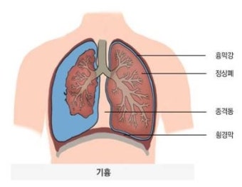 기흉 수술 후에 느껴지는 통증?