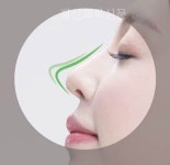 코필러ㆍ하이코, 후기와 가격 살펴보고 제품종류와 시술방법 잘 선택해야