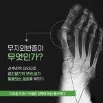 무지외반증 수술 회복 기간, 절골 방법 따라 달라져