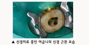 자연치아 살리기 1단계: 신경치료, 치주치료 -뉴연세치과 류성용 원장