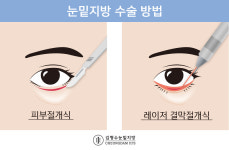 눈밑지방재배치 수술을 아시나요-서울에이치피부과 김형수