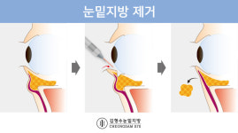 눈밑지방재배치 수술을 아시나요-서울에이치피부과 김형수