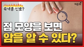 점과 암을 구분하는 자가진단법? ABCDE법칙을 기억하세요! (화순전남대학교병원 윤숙정, 국립암센터 송기훈)