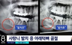 사랑니 뽑다 턱뼈 두 동강 내놓고 사과 안 한 제주도 모 치과