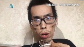 1년간 '직장암' 투병한 남성이 앙상해지는 모습 브이로그로 공개한 이유