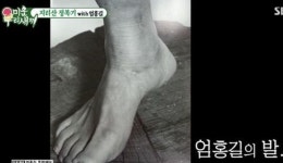 생살 썩어들어가는 고통...산 타다가 동상 걸렸던 산악인의 몸상태