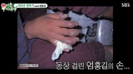 생살 썩어들어가는 고통...산 타다가 동상 걸렸던 산악인의 몸상태