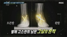 왼발 아파서 병원갔는데 오른발 수술당한 남성...병원은 언론에 알리지마 협박했다