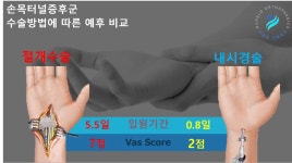 손목터널증후군, 초소형수부내시경 유리술로 부담 완화