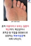 [카드뉴스]장마철 백선(무좀)에 주의하세요