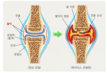 류마티스 관절염 환자 76%는 여성...여름철에 진료환자 증가