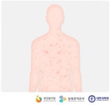 일본 풍진 유행,임신 1기에 감염되면  85% 태아 기형 위험 예방접종 필수