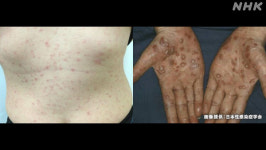 일본서 매독 감염자 급증 비상...올해 역대최다 1만명 넘는다