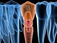 “레이, 中 JV 신설로 종합 덴탈솔루션 업체로 사업확장”