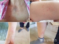 음성군 원남면 구안리 주민들, 원인 모를 피부병 집단 발생 고통 호소
