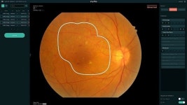 3대 실명원인질환 조기에 잡는 안저검사…인공지능과 만났다!