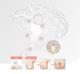 애니메디솔루션, 국내 최초 3D프린팅 의료기기 혁신의료기술 선정