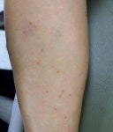 [좌담] 성병에 걸렸을 때 피부에 나타나는 증상