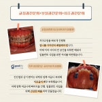 [이상민의 건치로 지키는 백세건강] 치과계의 오케스트라 양악수술, 수술 후 관리 필수