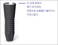[이상민의 건치로 지키는 백세건강] ④슬기로운 임플란트 선택법(完)