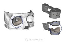 애니메디솔루션, 안와골절 임플란트 가이드 혁신의료기술 선정