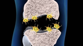  광주 새나래병원, “퇴행성 관절염, 초기에 빠른 진단과 치료 중요해” 