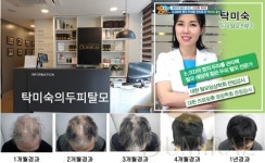 두미래, 한국인에 딱 맞는 탈모치료 및 예방법 선보여