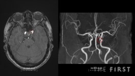 딥노이드, 뇌동맥류 뇌영상검출·진단보조소프트웨어 딥뉴로(DEEP:NEURO) 혁신의료기술 선정