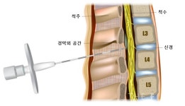 자생한방병원, 한약재 성분 쥐 경막외 투여해 척추관협착증 치료 효과 입증 SCI(E)급 국제학술지 게재