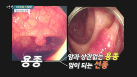 [EBS 명의] 소화기내과 기태일 교수, 소화기외과 김희철 교수의 대장의 혹 용종, 암일까?