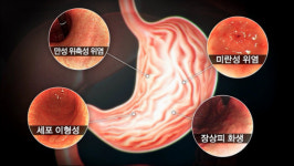 [EBS 명의] 전한호 교수의 만성위염·위축성위염·장상피화생 등 방치하면 위암이 된다! 증상과 치료법 공개!