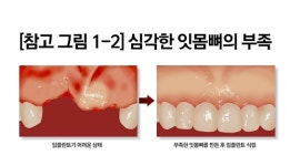 임플란트에 부족한 치조골, 환자 상태에 따라 뼈 만드는 방법 달라져