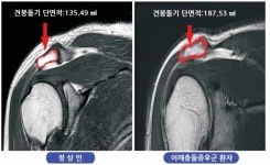 어깨충돌증후군 환자,정상인보다 어깨뼈 단면적 더 두꺼워