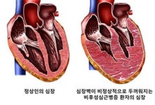 심장근육 두꺼운 '비후성 심근증',  LV-GLS에 따라 사망위험 달라