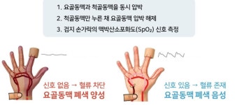 서울대병원, 영유아 수술 후 요골동맥 폐색 예방 최초 규명