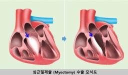 삼성서울병원, 비후성심근증 심근절제술 100 예