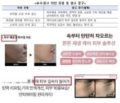 마이크로니들 화장품 허위·과대광고 성행