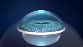 눈에미소안과, 3D 렌즈삽입술 전 과정 전담 책임제 구축